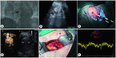 Minimally invasive repair of iatrogenic right ventricular perforation guided by bedside contrast-enhanced ultrasound: A case report and literature review